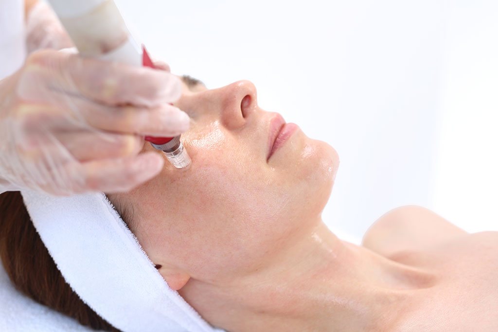 microneedling treatment